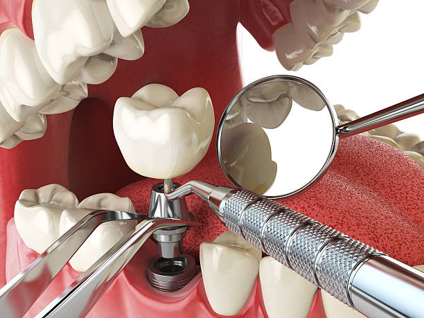 Best Broken or Cracked Tooth Emergency Dentist in Denton, MD